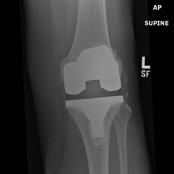 knee-surgery1