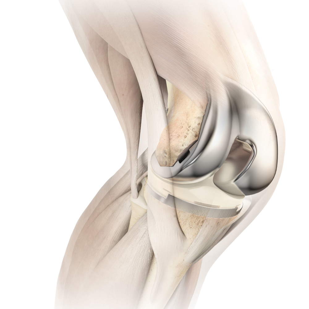 knee-surgery2