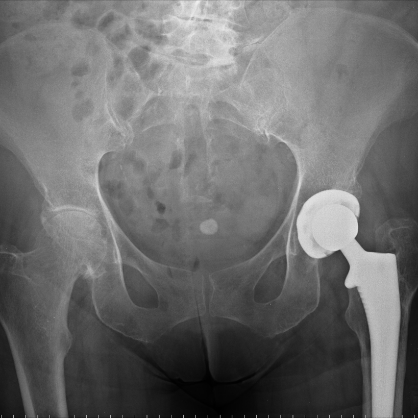 What's new in hip surgery